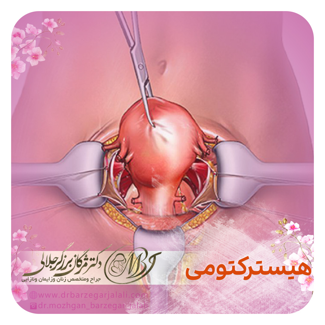 هیسترکتومی