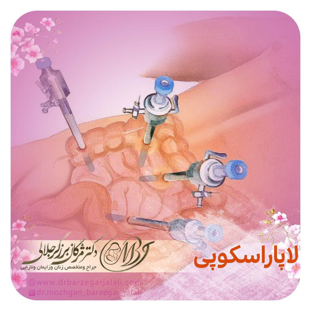 لاپاراسکوپی