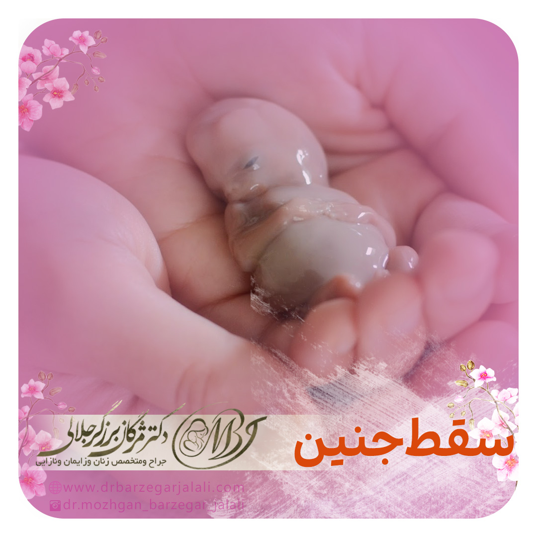 سقط مکرر جنین